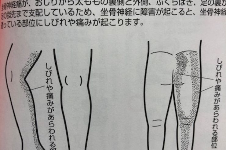 戸田市　痺れ